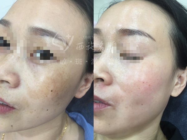 真的能行！不提取，不剝脫，涂抹就下“斑”