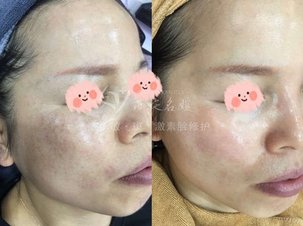 真的能行！不提取，不剝脫，涂抹就下“斑”